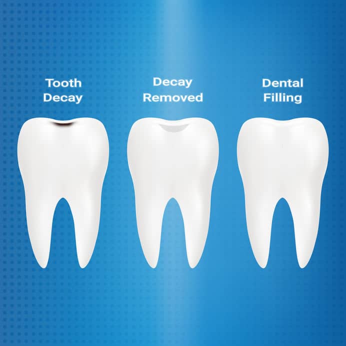 Sand Springs Dental Crown