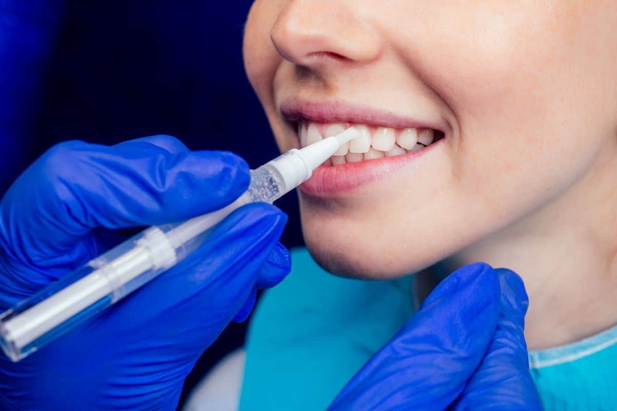 How Long Do Crowns Last On Your Teeth? Dentistry For You Sand