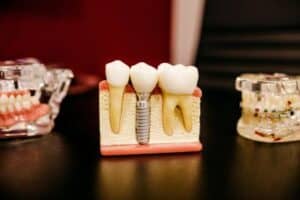Is losing a crown a dental emergency
