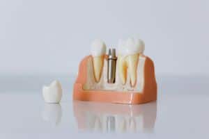 All-On-4® Dental Implants